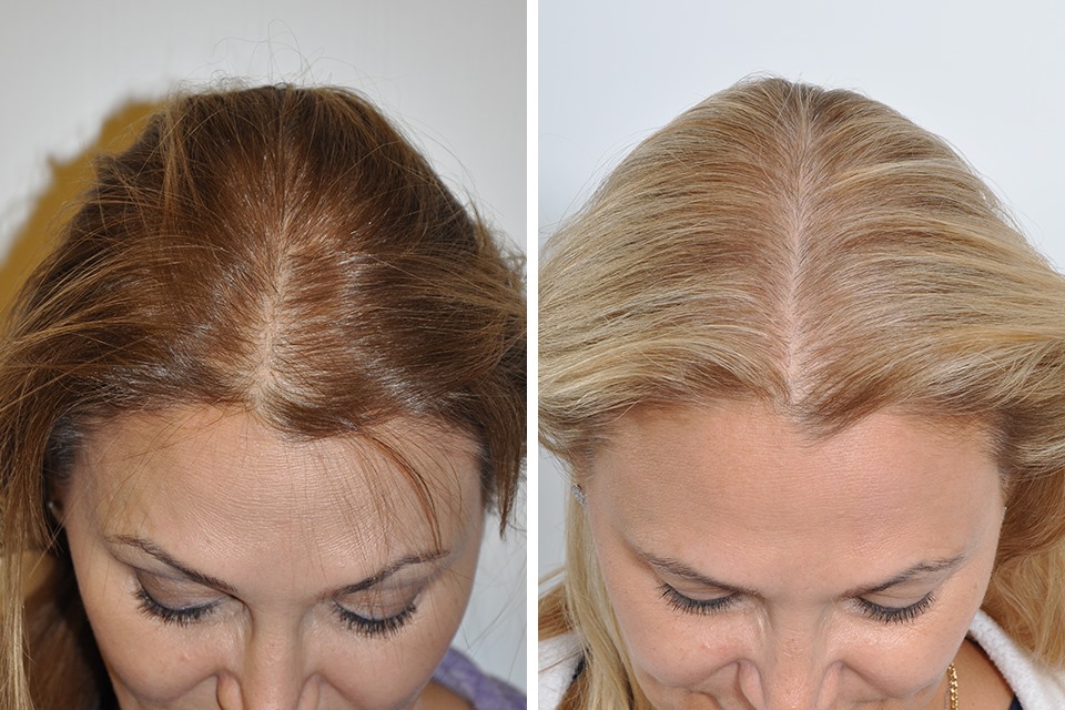 Hair Transplant – Transform Your Look and Confidence