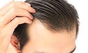 Hair Transplant Istanbul: Experience Medical Tourism with Comfort