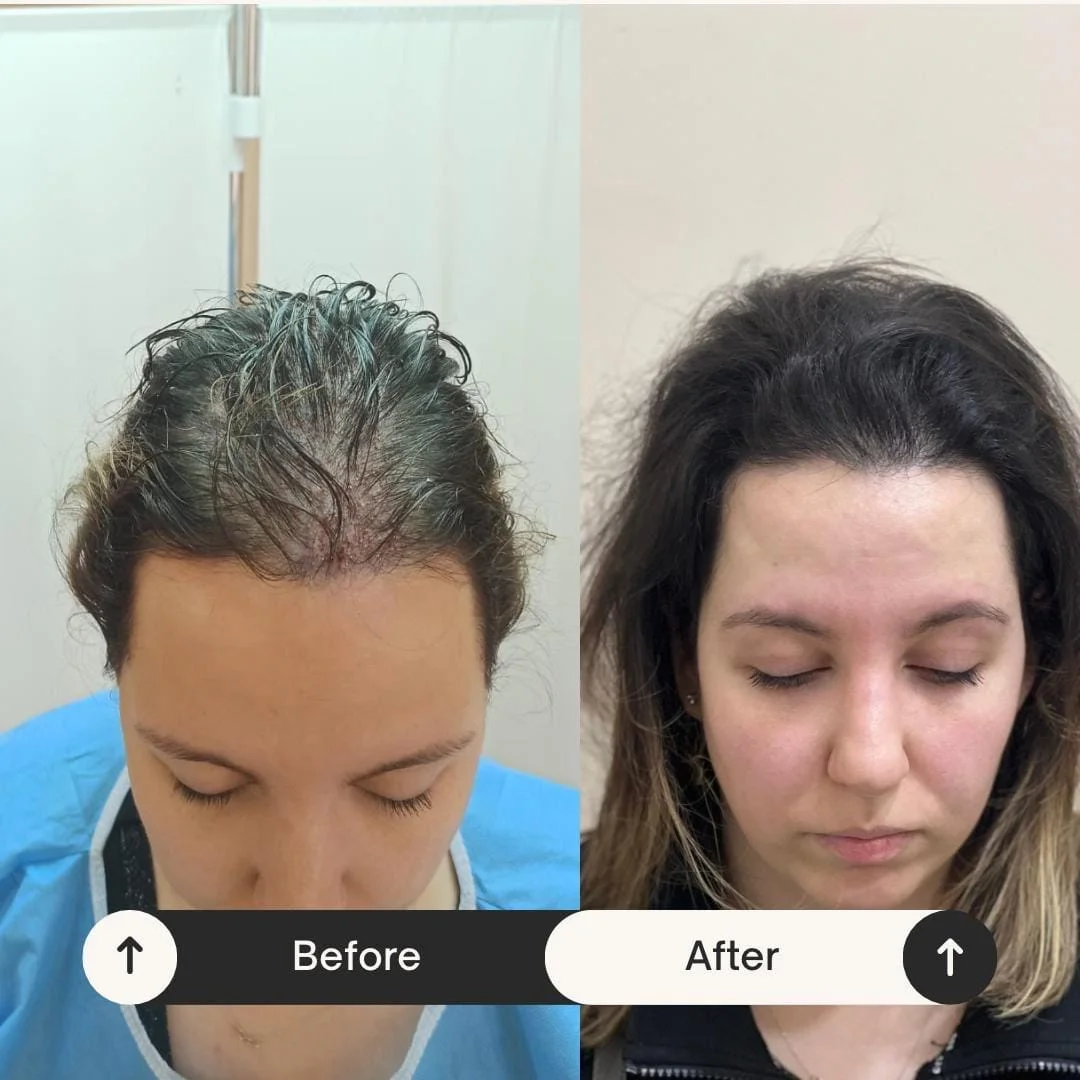 Hair Transplant UK – Restore Confidence with the Experts