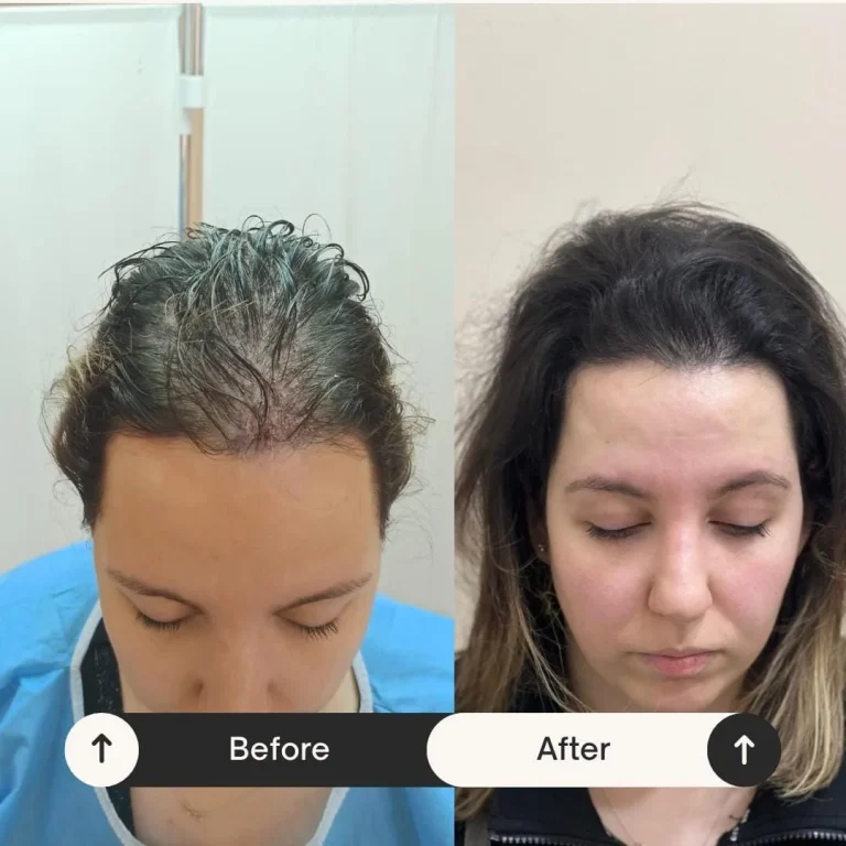 wellzone-clinics-hair-transplant-5